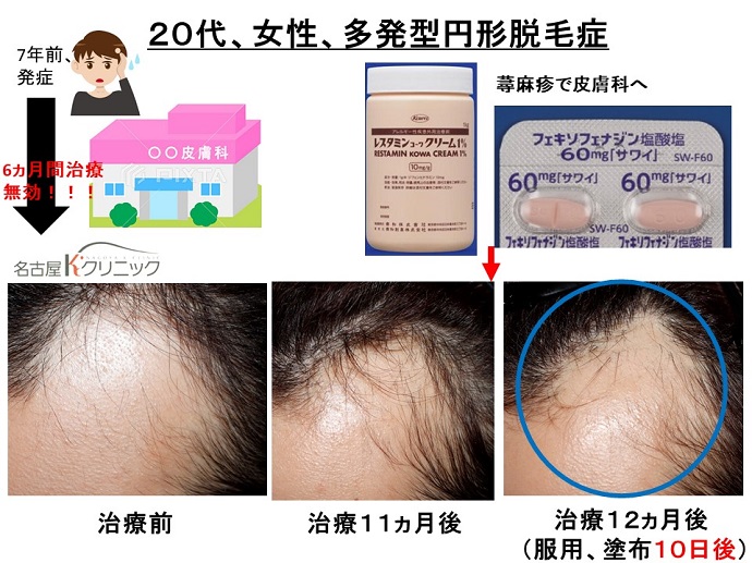 円形脱毛症　病院